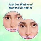 DR.RASHEL Korean Nose Pore Strips | With 1% ceramides and Rice Water| Deep Cleansing | Pore Tightening | Blackhead Removal | 10 Strips